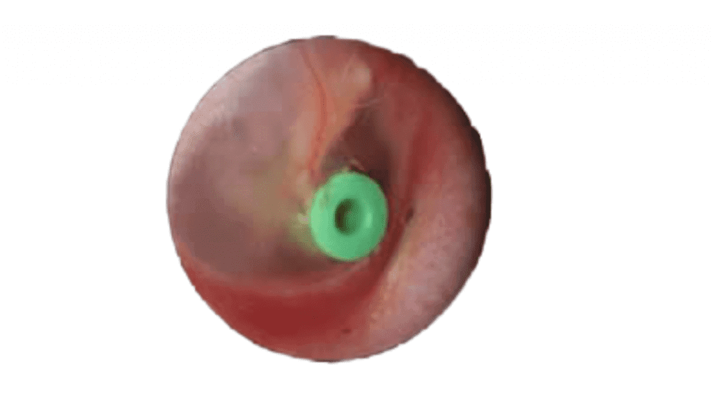 Otitis media with effusion (fluid in the ears)