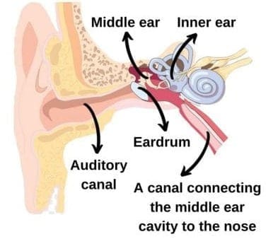 Otitis Media With Effusion (Fluid In The Ears)
