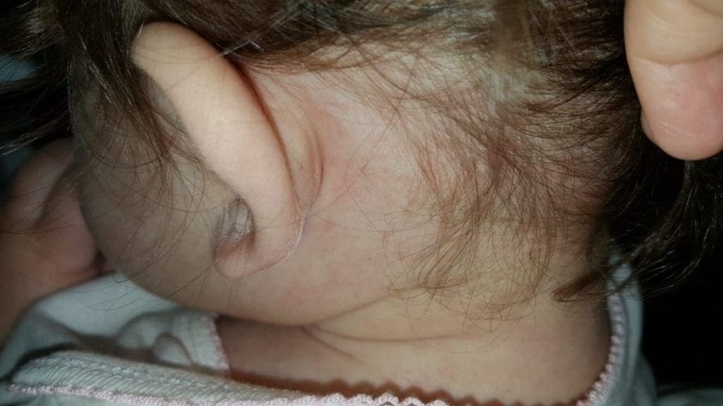 Roseola infantum or Sixth disease