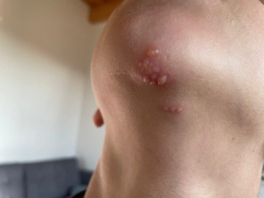 Herpatic skin infection (herpes gladiatorum)