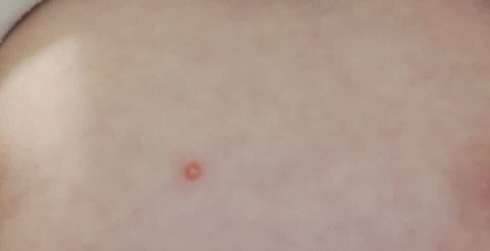 Molluscum Contagiosum (viral Warts) - Doctor Efi