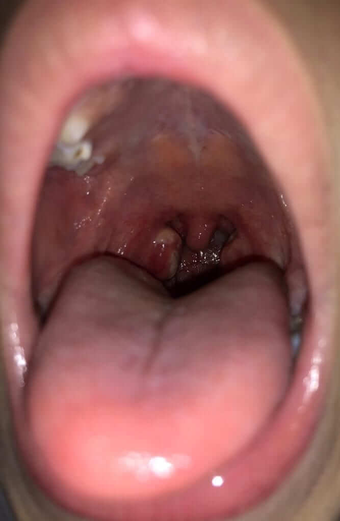 PFAPA (periodic fever, aphthous stomatitis, pharyngitis and adenitis) in children and adolescent – recurrent fever with sore throat