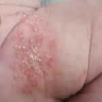 A secondary infection with Candida