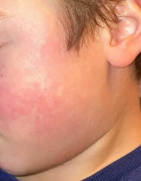 Parvovirus (1) Infection in Children (Fifth disease or Erythema Infectiosum)