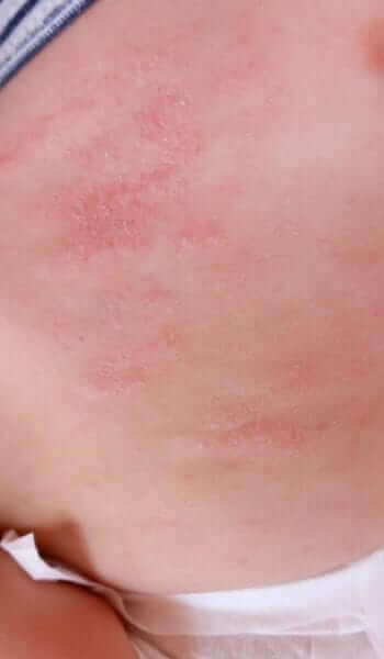 Atopic dermatitis