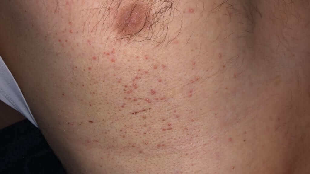 Folliculitis