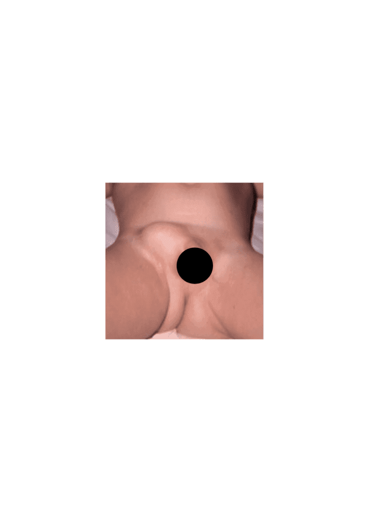 Inguinal hernia and hydrocele in children