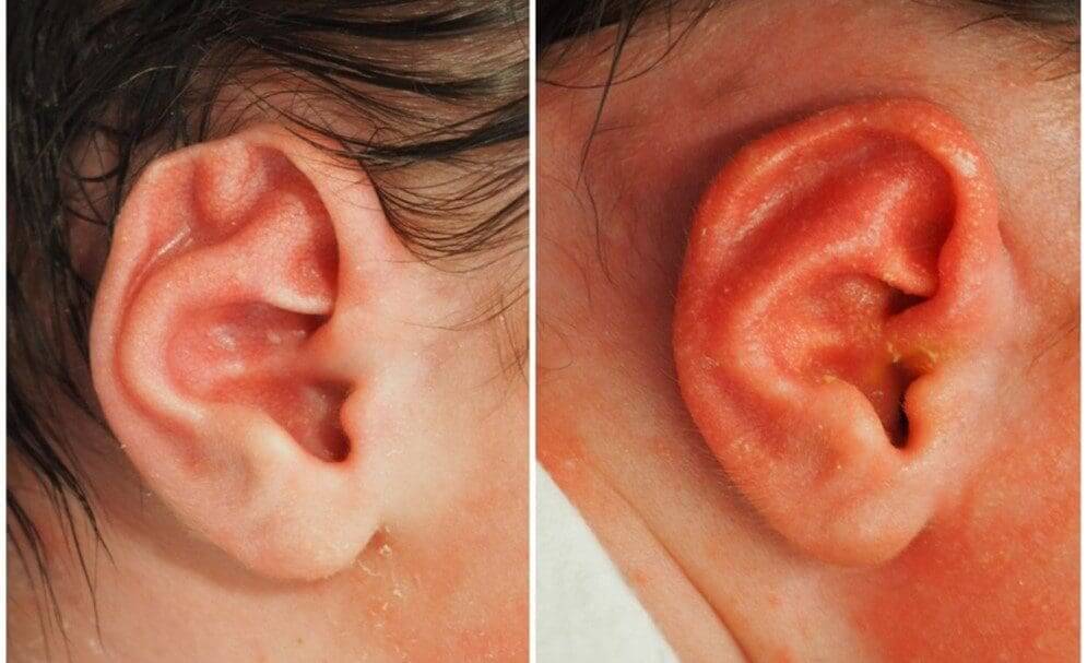 Baby ear deformities