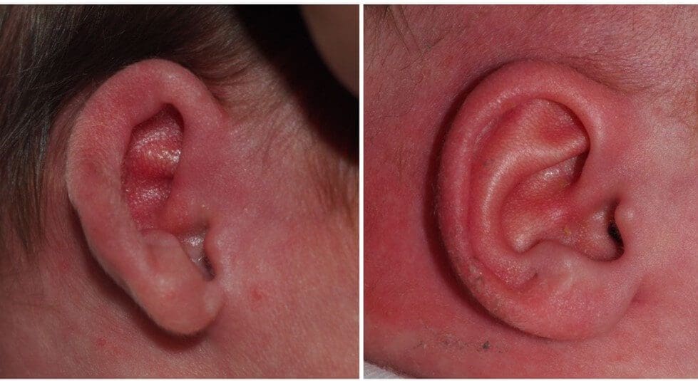 Baby ear deformities2