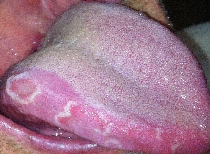 Geographic tongue 2