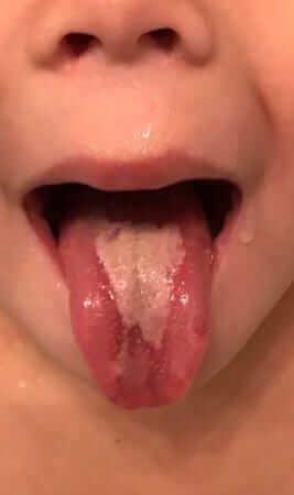 Oral Thrush (oral candidiasis) in Children1