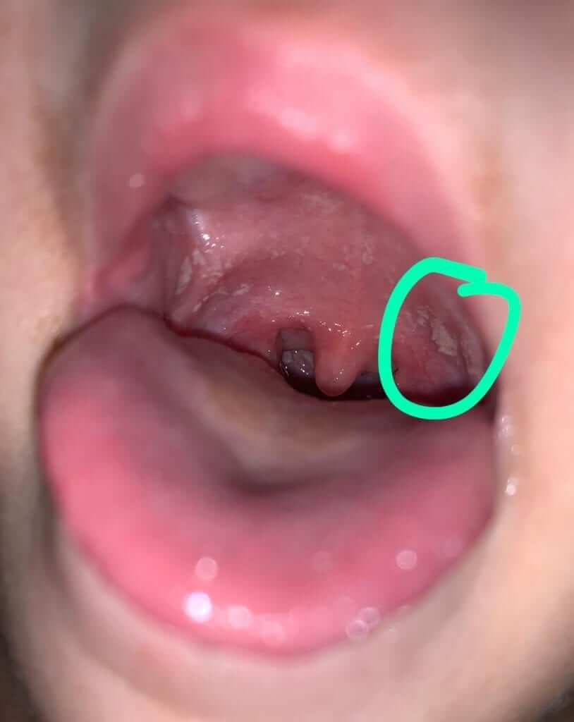 Oral Thrush (oral candidiasis) in Children2