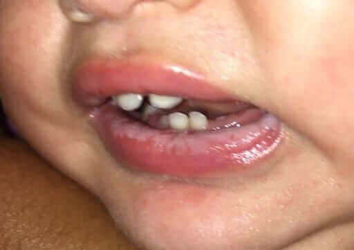Oral Thrush (oral candidiasis) in Children3