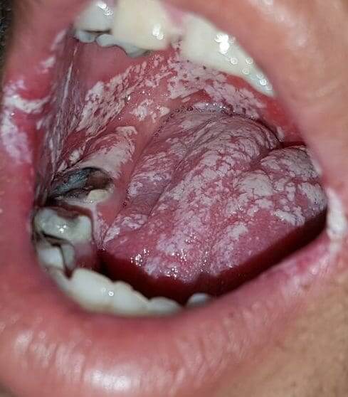 Oral thrush (oral candidiasis) in children