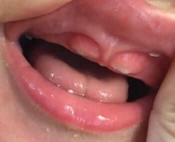 Teething in babies and children