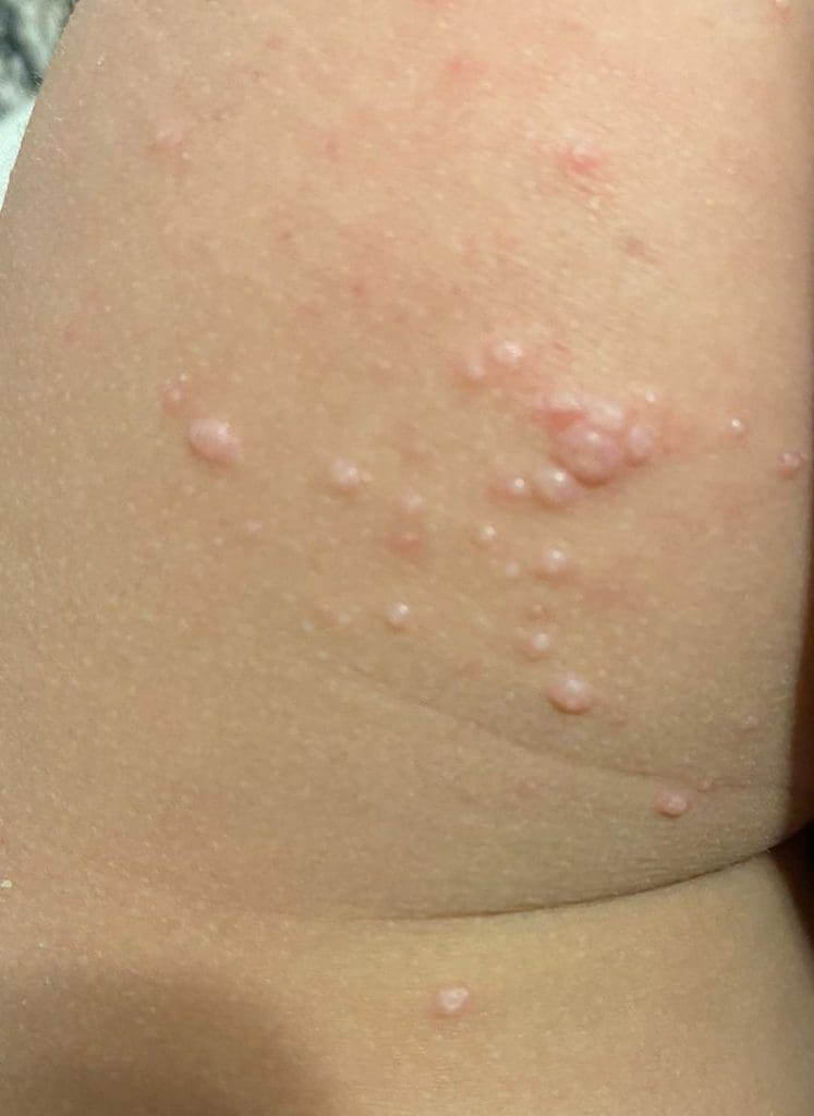 Molluscum contagiosum- viral warts