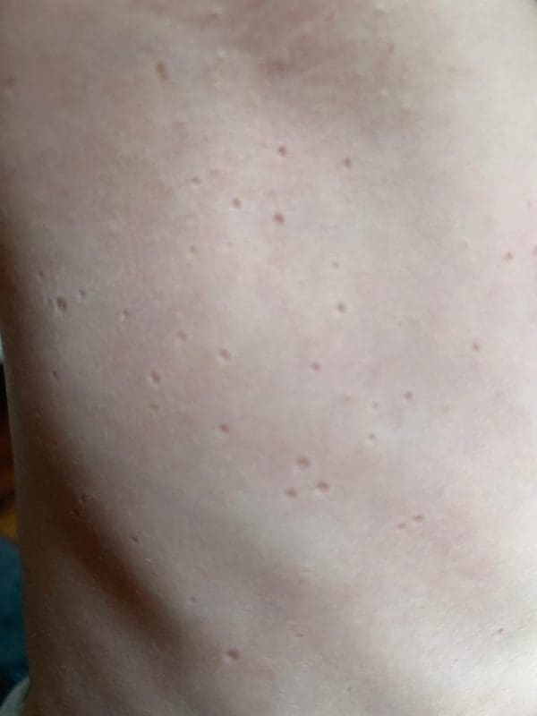 Spontaneous pitted scarring after molluscum contagiosum