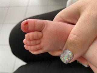 Ingrown nail in infants and young children
