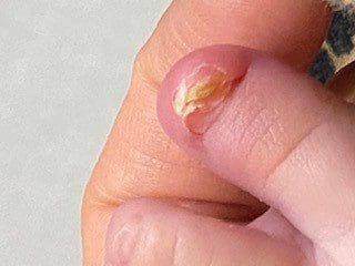 Ingrown nails in infants and young children2