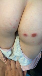 Recurrent skin infections