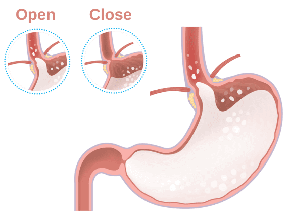 Reflux (spit-ups) in babies