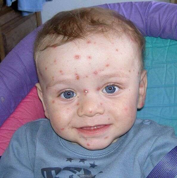 Chickenpox (Varicella)