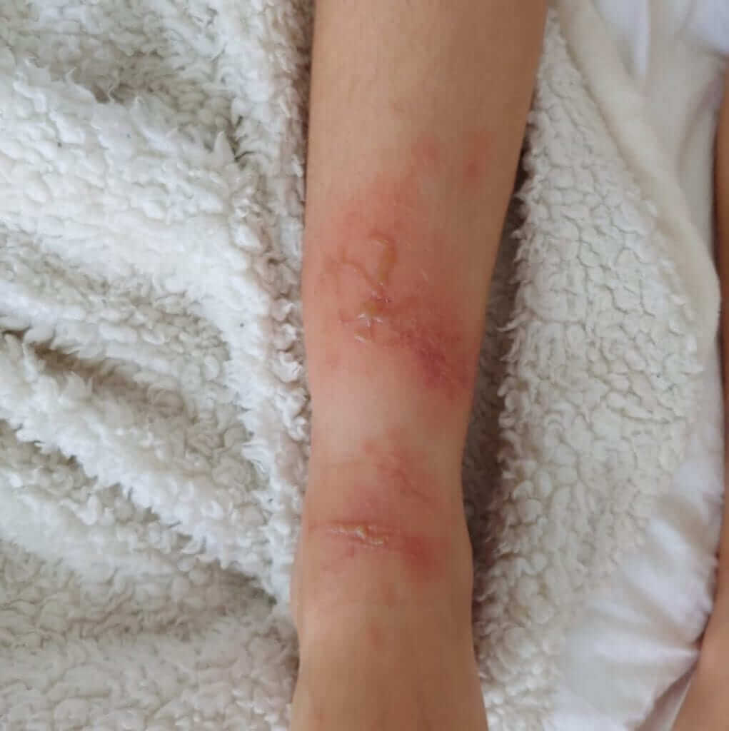 Jellyfish stings in children and adults