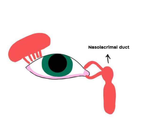 Nasolacrimal duct obstruction (blocked tear-ducts) in infants