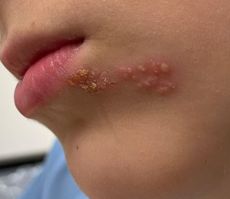 Herpes labialis (cold sore or fever blister)