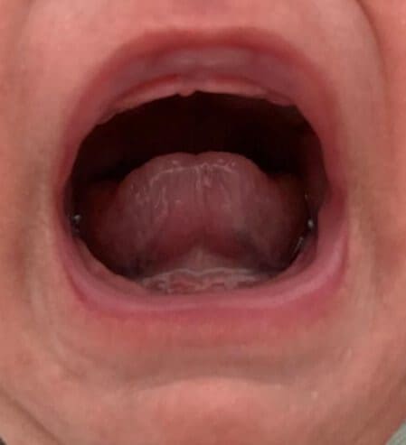 Tongue-tie (ankyloglossia) in infants