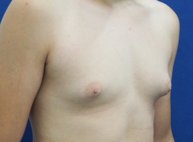 Gynecomastia (breast enlargement) in adolescents