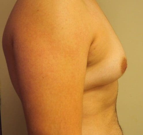 Gynecomastia (breast enlargement) in adolescents