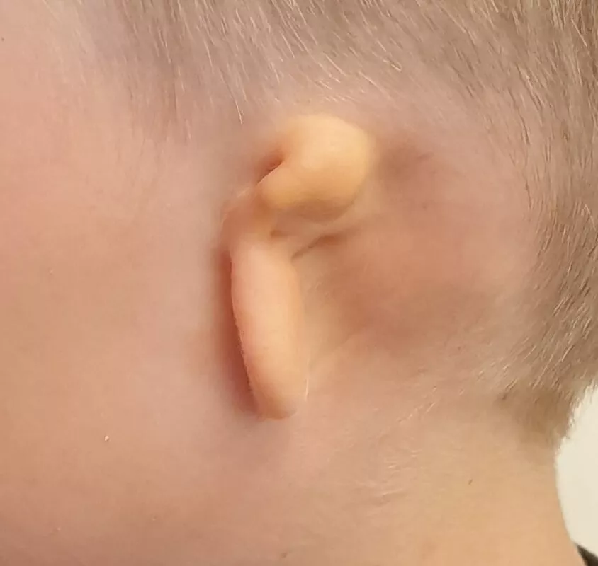 Microtia and ear reconstruction