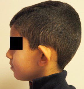 Protruding ears in children and ear pinning surgeries - 2