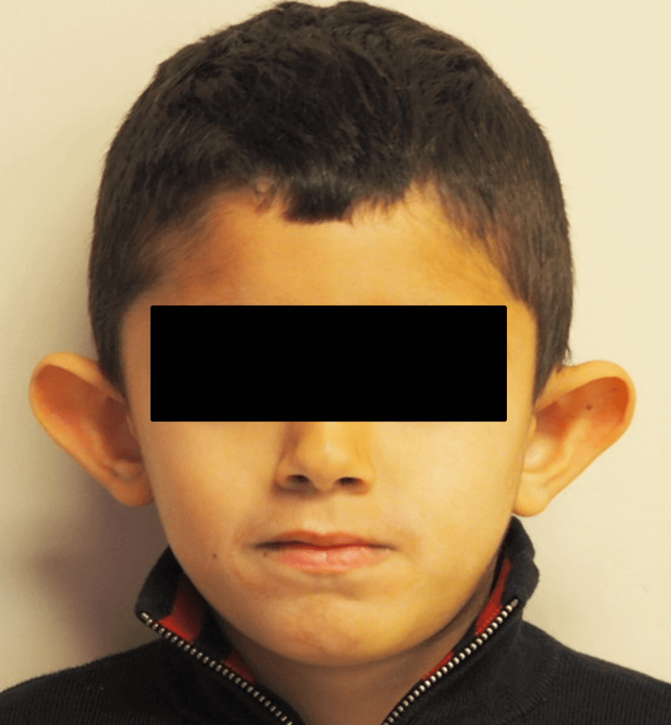 Protruding ears in children and ear pinning surgeries