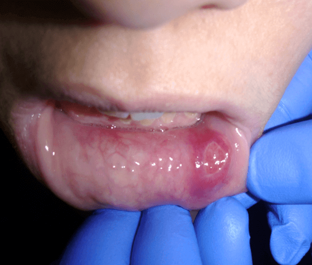 Everything you need to know about recurrent aphthous stomatitis (canker sores) in children (and adults)