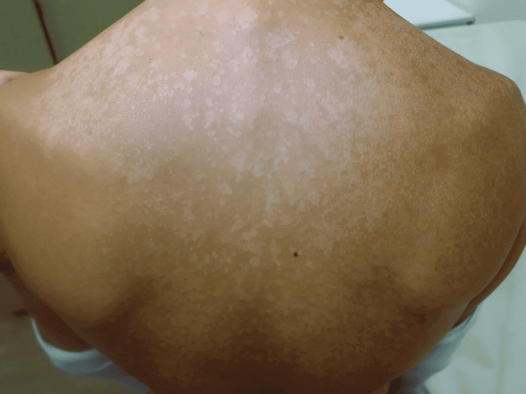 Everything you need to know about sun fungus (pityriasis versicolor) in children and adults