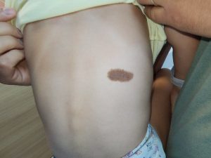 Everything you need to know about moles (beauty marks) in children