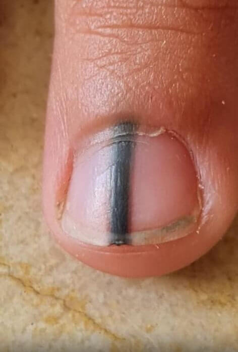 A black pigmentation of the nail – Melanonychia