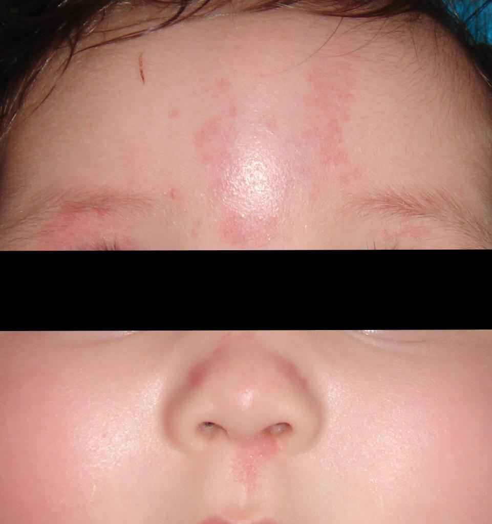 A Skin Lesion in Infants –Nevus Flammeus Simplex