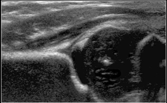 Hip ultrasounds in infants for DDH detection – in the words of a radiologist