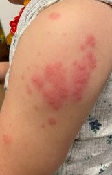 Everything you need to know about shingles (varicella zoster) in children and adults