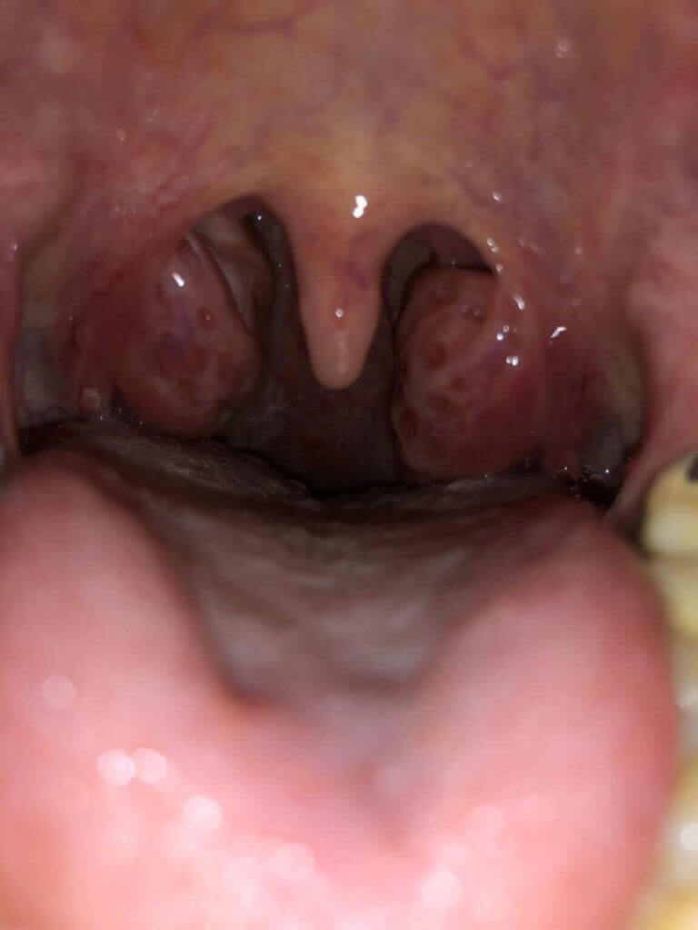 Tonsil reduction or resection in children