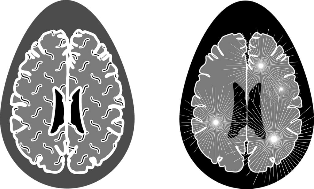 Naegleria Fowleri the Brain-Eating Amoeba or primary amoebic meningoencephalitis (PAM)