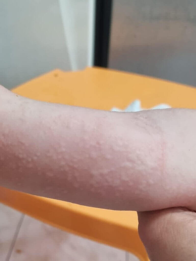 Urticaria in children