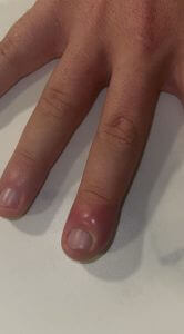 Paronychia - an infection of the nail bed