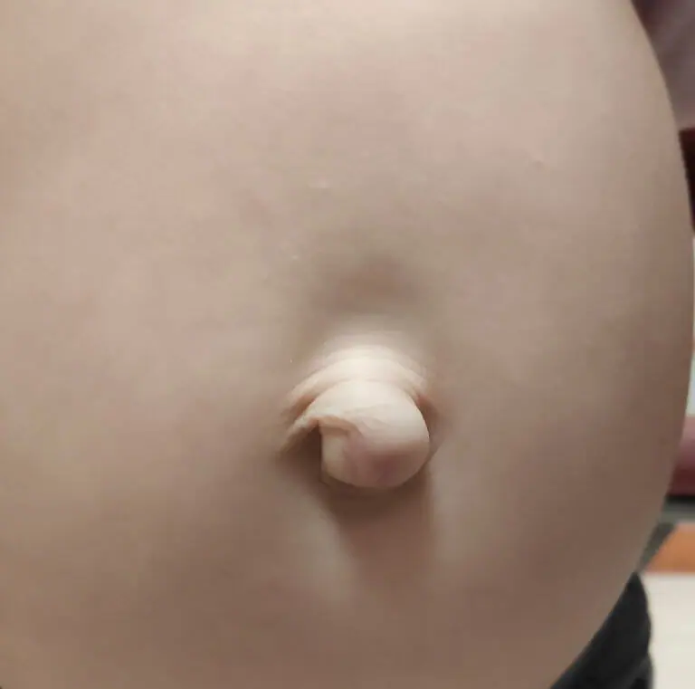 Umbilical hernia in babies and children