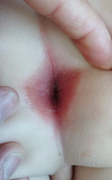 Perianal dermatitis in children